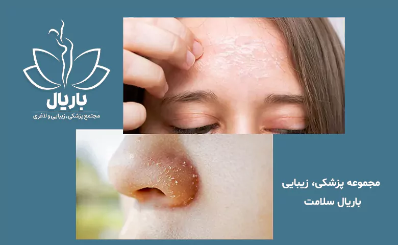 پوسته پوسته شدن صورت